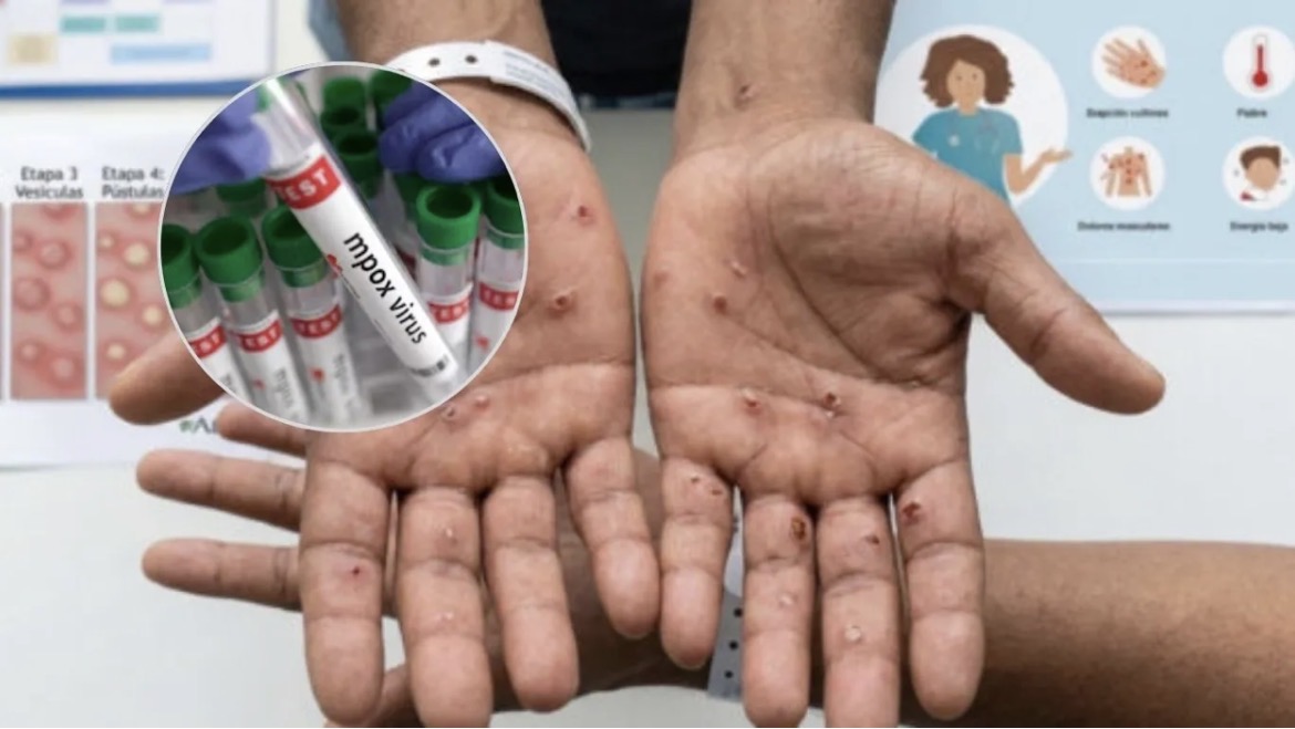 Colombia detecta primer caso de mpox Clado Ib en Antioquia y activa protocolos de vigilancia