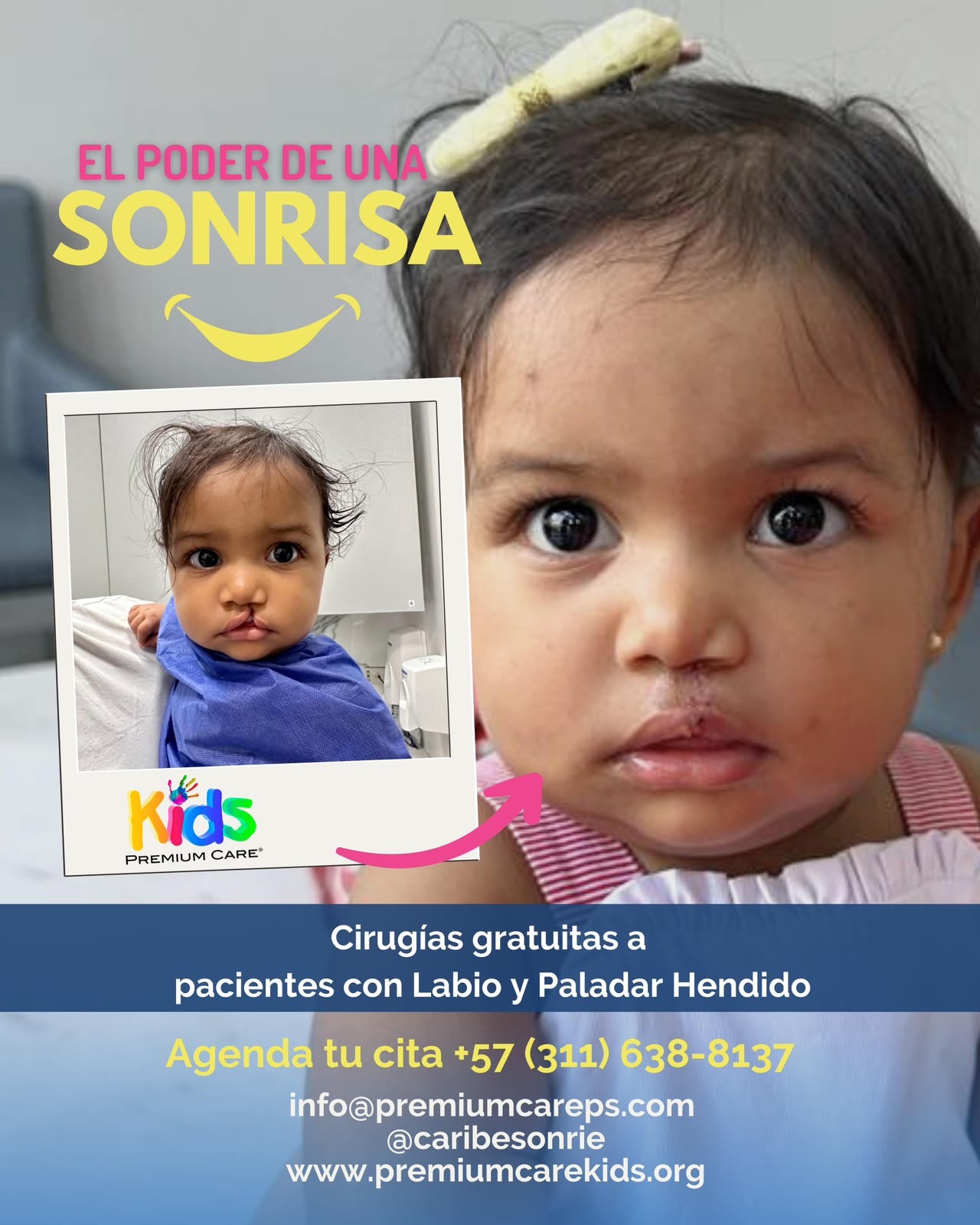 Caribe Sonríe ofrecerá cirugías gratuitas a niños con labio y paladar hendido en Colombia